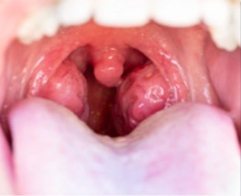 Cirurgia das Amígdalas